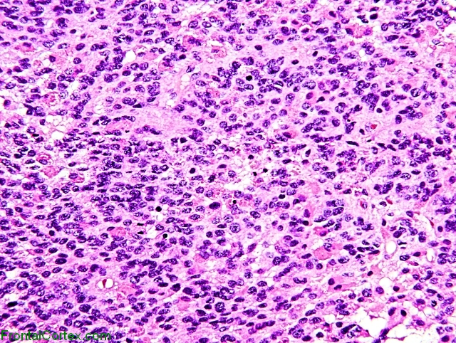 anaplastic ependymoma x200